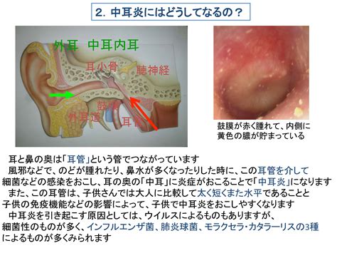 穴汁|耳だれがある・中耳炎のお悩みは尼崎市のほんじょう。